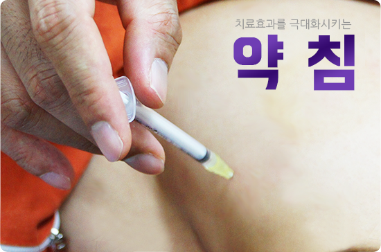 약침